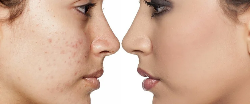 بهترین کرم برای از بین بردن لک