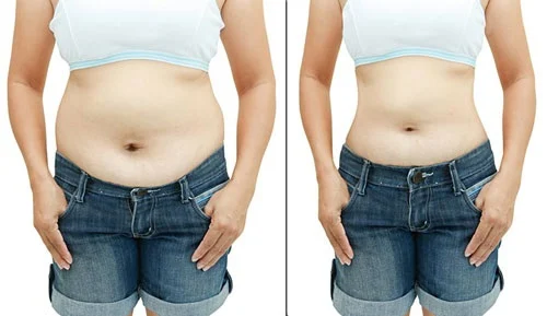 پعوارض جراحی شکم ابدومینوپلاستی