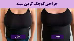 Complications-of-breast-reduction-surgery