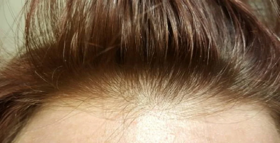What is the newest treatment for hereditary hair loss?