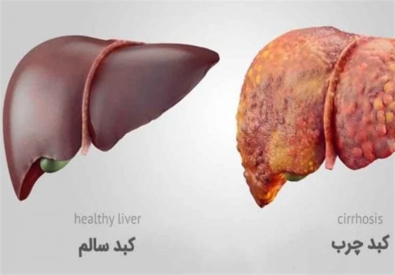 طب سنتی |کبد چرب
