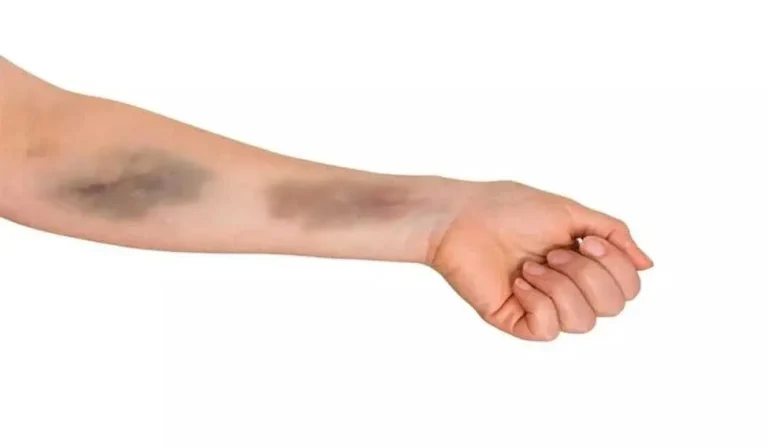 علت خونریزی زیر پوستی یا پورپورا چیست؟
