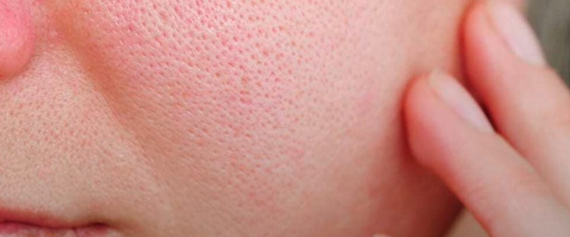 تاثیر پوست چرب بر بزرگی منافذ