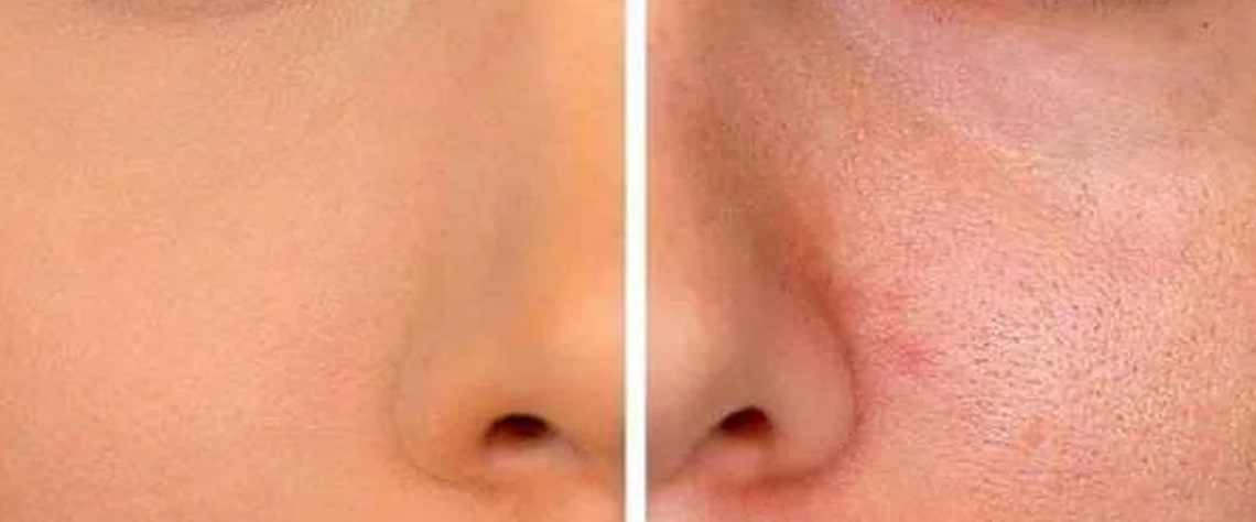 پاکسازی |پوست