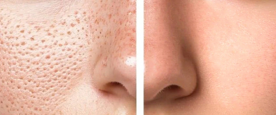 نقش سبک زندگی و تغذیه در سلامت پوست و منافذ